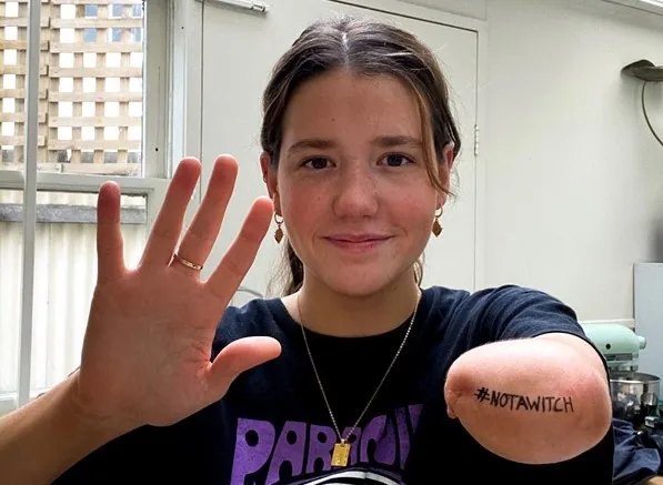 A person showing a limb difference and a Not a Witch message